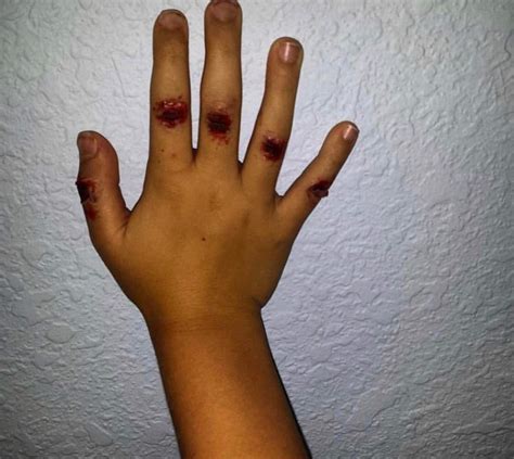 Bloody knuckles .